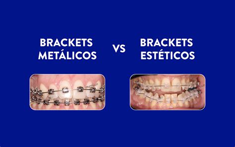 diferencias entre brackets metalicos y esteticos|Diferencias entre brackets estéticos y brackets metálicos.